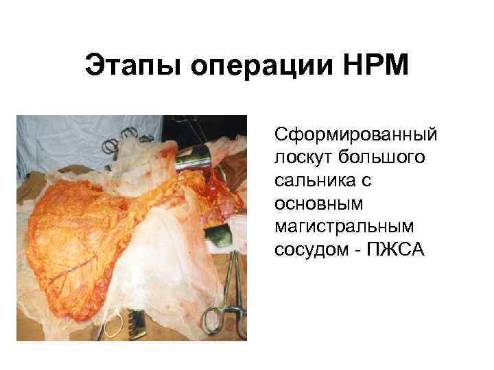 Этапы операции НРМ • Сформированный лоскут большого сальника с основным магистральным сосудом - ПЖСА