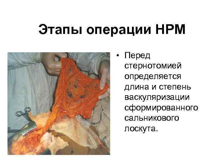 Этапы операции НРМ • Перед стернотомией определяется длина и степень васкуляризации сформированного сальникового лоскута.