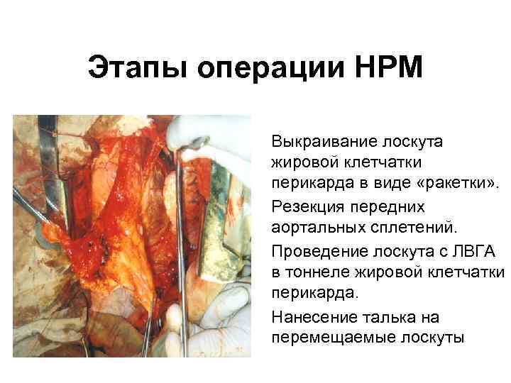 Этапы операции НРМ • Выкраивание лоскута жировой клетчатки перикарда в виде «ракетки» . •