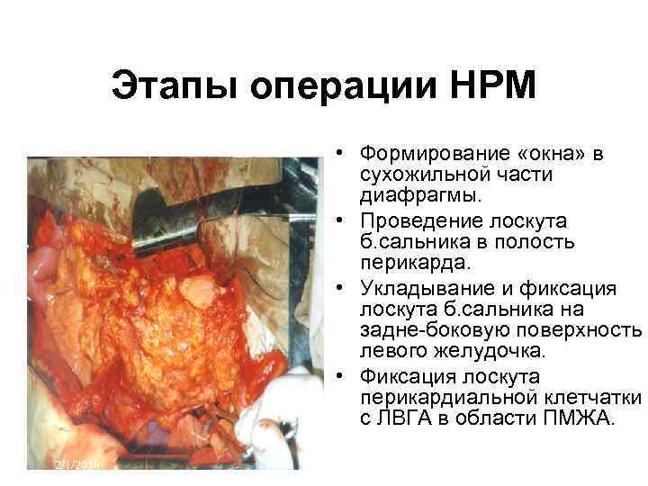 Этапы операции НРМ • Формирование «окна» в сухожильной части диафрагмы. • Проведение лоскута б.