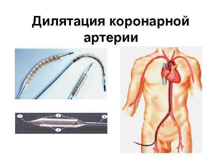 Дилятация коронарной артерии 2/1/2018 