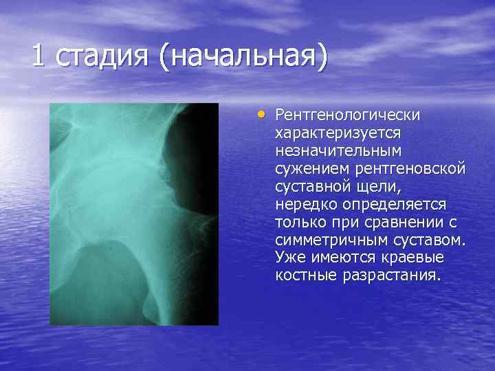 1 стадия (начальная) • Рентгенологически характеризуется незначительным сужением рентгеновской суставной щели, нередко определяется только