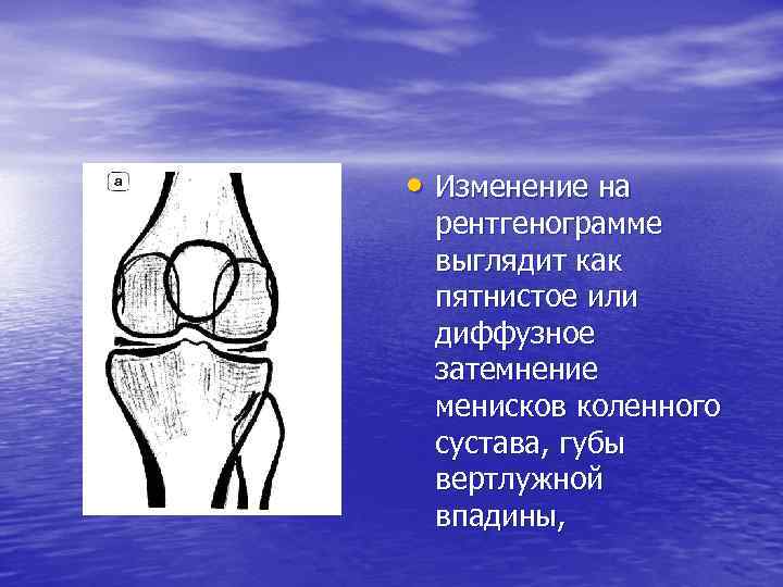  • Изменение на рентгенограмме выглядит как пятнистое или диффузное затемнение менисков коленного сустава,
