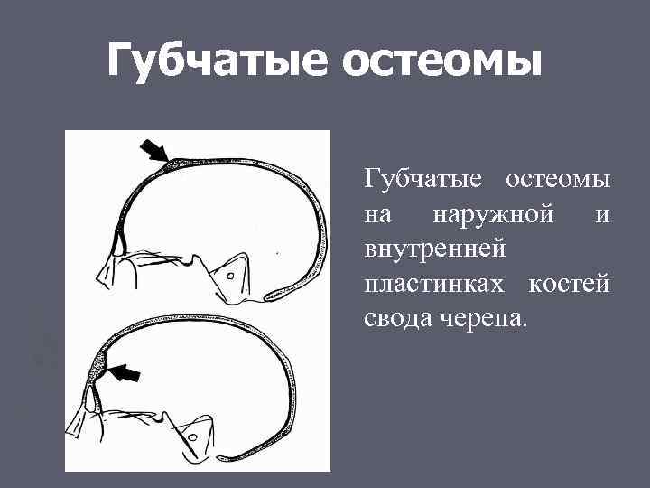 Губчатые остеомы на наружной и внутренней пластинках костей свода черепа. 
