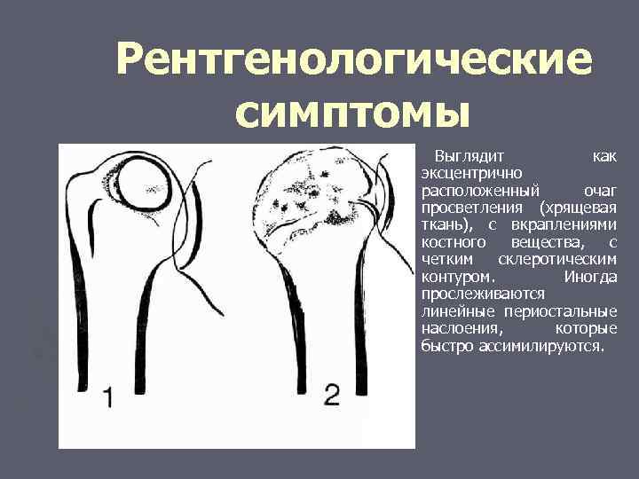 Рентгенологические симптомы Выглядит как эксцентрично расположенный очаг просветления (хрящевая ткань), с вкраплениями костного вещества,