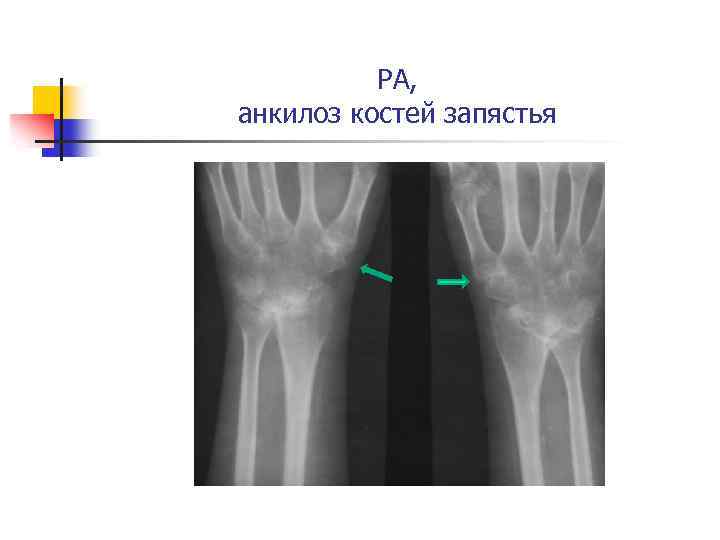 РА, анкилоз костей запястья 