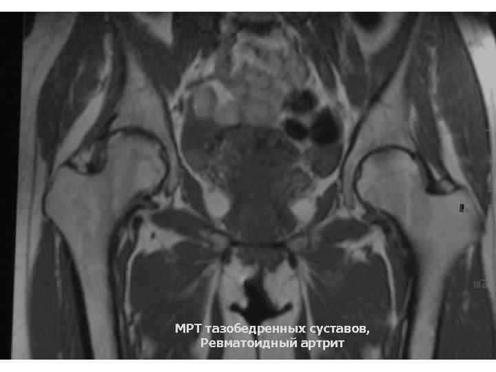 Что покажет мрт тазобедренного сустава у женщин. Артрит тазобедренного сустава мрт. Трохантерит тазобедренного сустава мрт. Ревматоидный артрит тазобедренного сустава мрт. Гнойный артрит тазобедренного сустава кт.