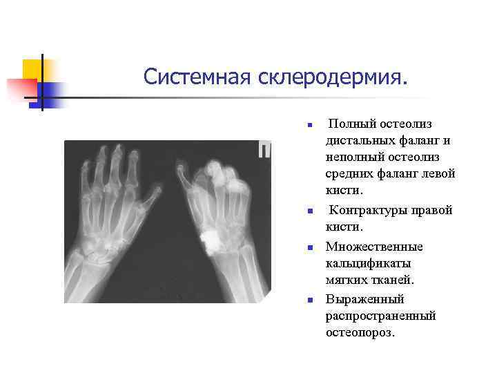 Системная склеродермия. n n Полный остеолиз дистальных фаланг и неполный остеолиз средних фаланг левой