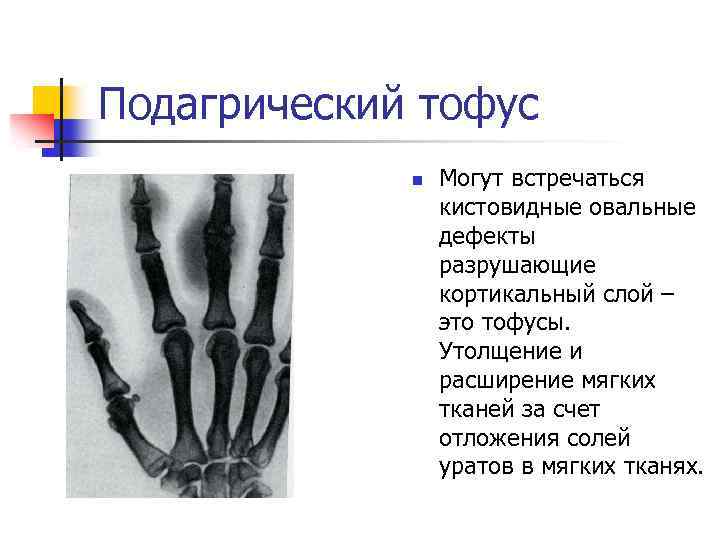 Подагрический тофус n Могут встречаться кистовидные овальные дефекты разрушающие кортикальный слой – это тофусы.