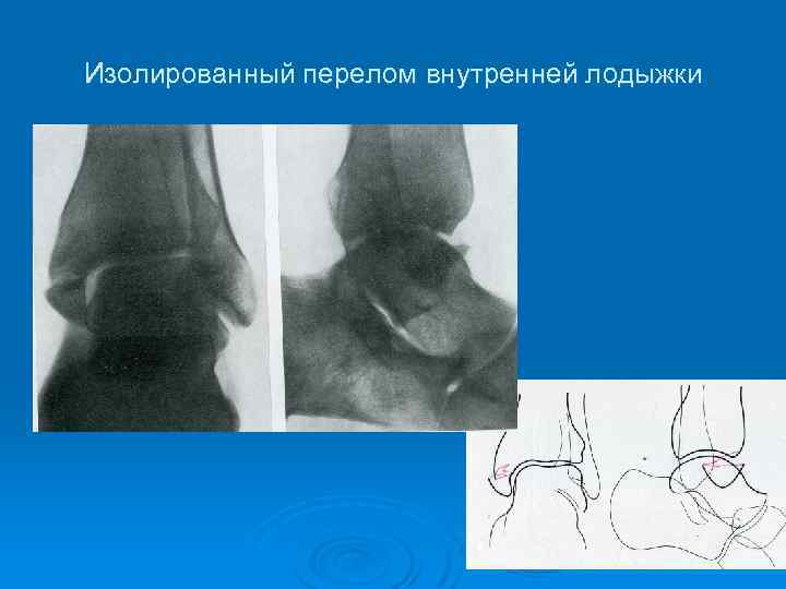 Изолированный перелом внутренней лодыжки 