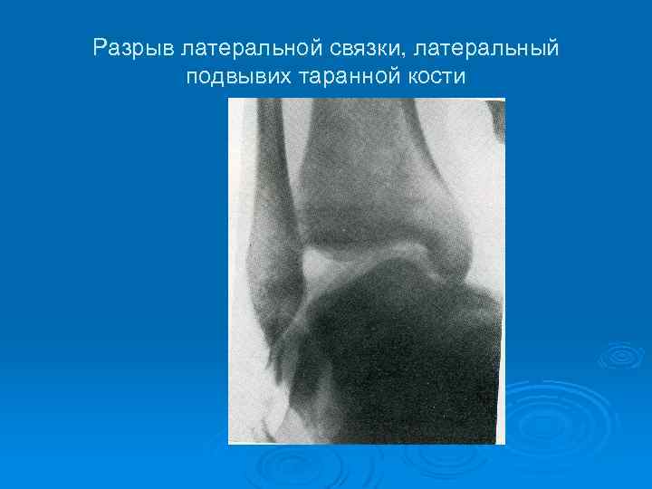 Разрыв латеральной связки, латеральный подвывих таранной кости 