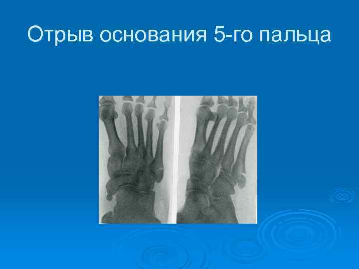 Отрыв основания 5 -го пальца 