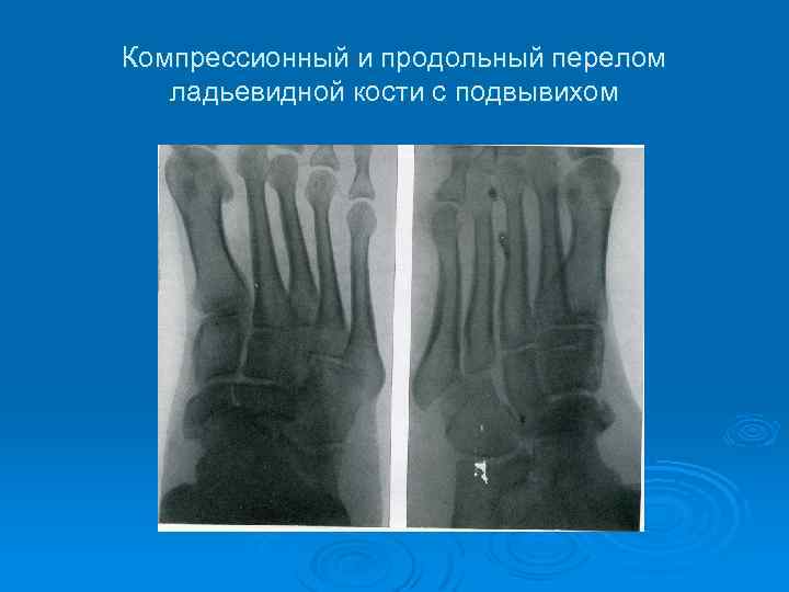 Компрессионный и продольный перелом ладьевидной кости с подвывихом 