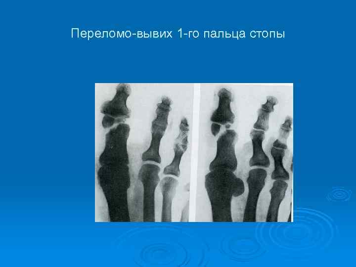 Переломо-вывих 1 -го пальца стопы 