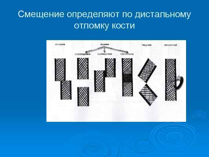 Смещение определяют по дистальному отломку кости 