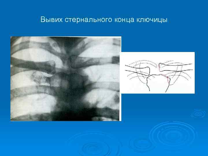 Вывих стернального конца ключицы 