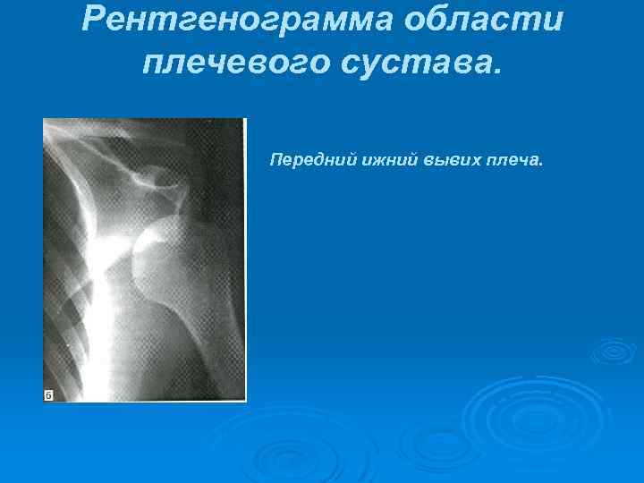Рентгенограмма области плечевого сустава. Передний ижний вывих плеча. 