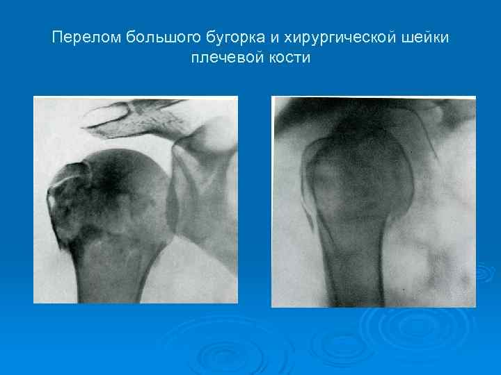 Перелом большого бугорка левого плеча показать фото