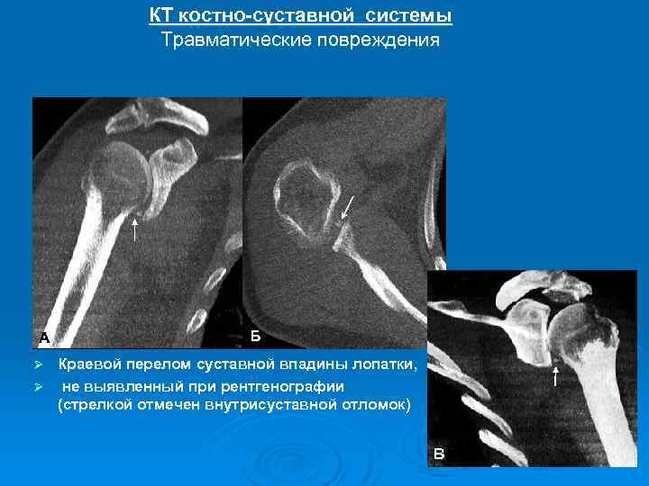 Кт картина краевой деструкции смежных костей наиболее характерна для