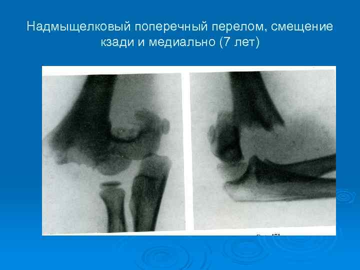 Надмыщелковый поперечный перелом, смещение кзади и медиально (7 лет) 