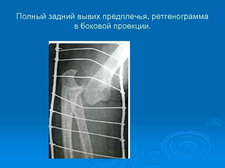 Полный задний вывих предплечья, ретгенограмма в боковой проекции. 