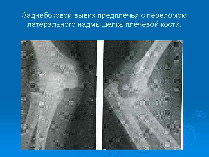 Перелом предплечья травматология презентация