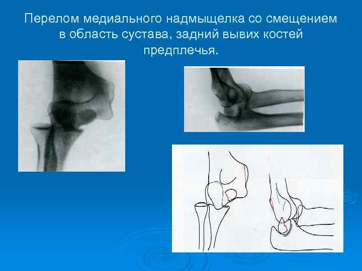 Открытый перелом предплечья карта вызова