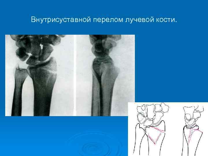 Внутрисуставной перелом. Внутрисуставной оскольчатый перелом луча. Внутрисуставной перелом лучевой кости. Краевой внутрисуставной перелом. Краевой перелом лучевой кости рентген.