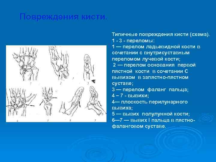 Переломы кисти травматология презентация