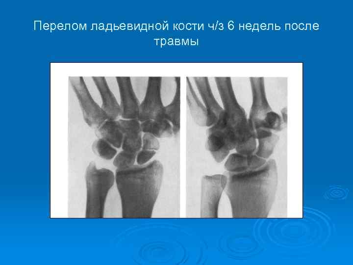 Перелом ладьевидной кости. Оскольчатый перелом ладьевидной кости. Перелом ладьевидной кости кисти классификация. Оскольчатый перелом ладьевидной кости кисти. Вывих лучевой кости и перелом ладьевидной.
