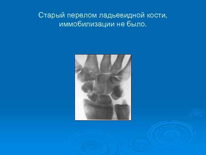 Старый перелом ладьевидной кости, иммобилизации не было. 