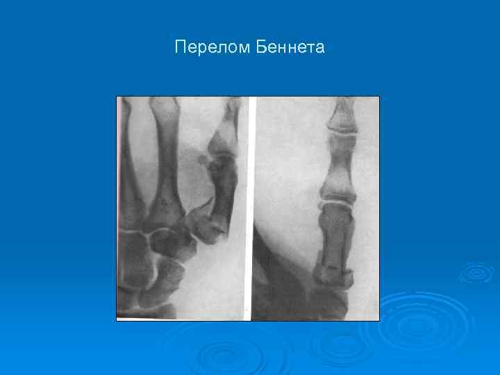 Перелом Беннета 