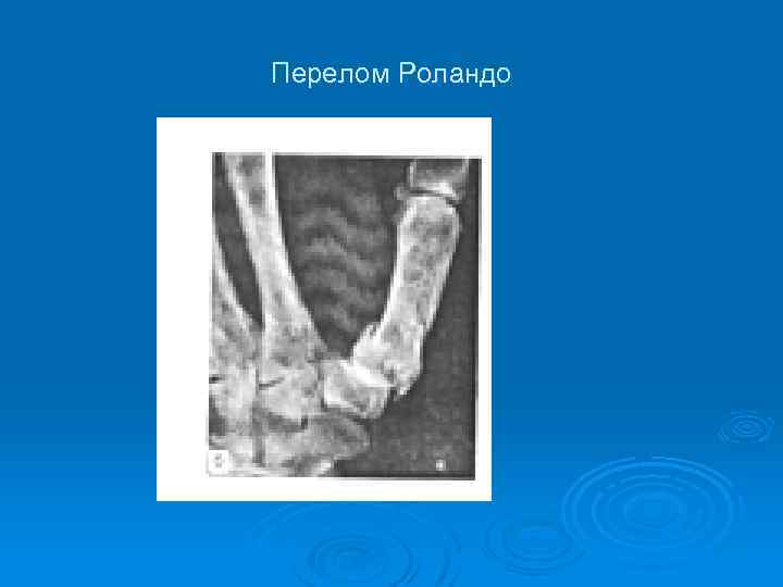 Перелом Роландо 