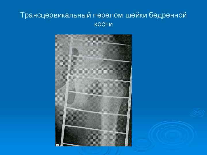 Трансцервикальный перелом шейки бедренной кости 