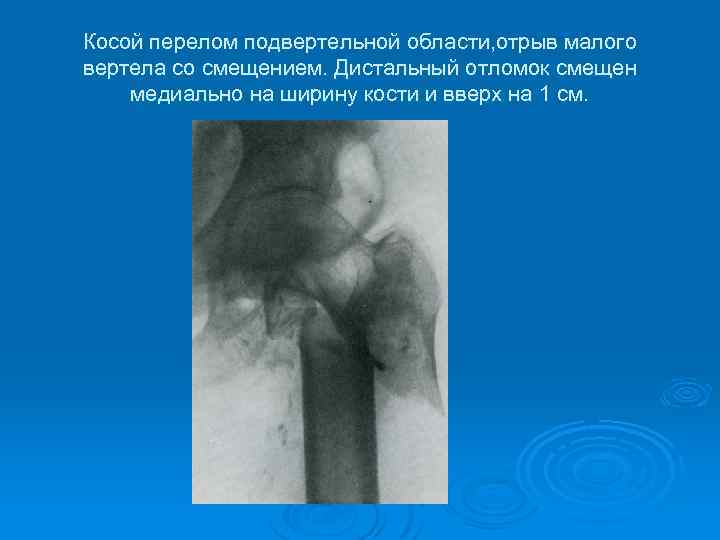 Косой перелом подвертельной области, отрыв малого вертела со смещением. Дистальный отломок смещен медиально на