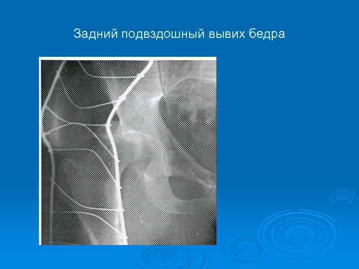 Задний подвздошный вывих бедра 