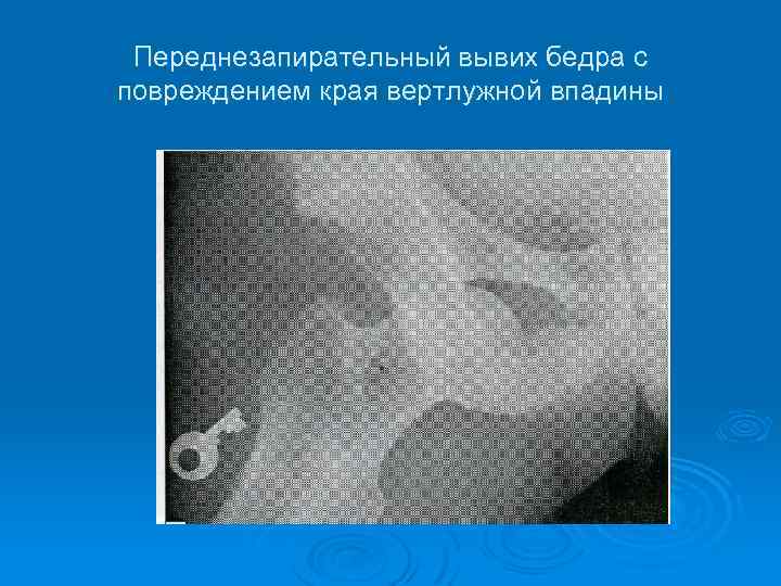 Переднезапирательный вывих бедра с повреждением края вертлужной впадины 