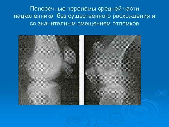 Перелом надколенника после операции