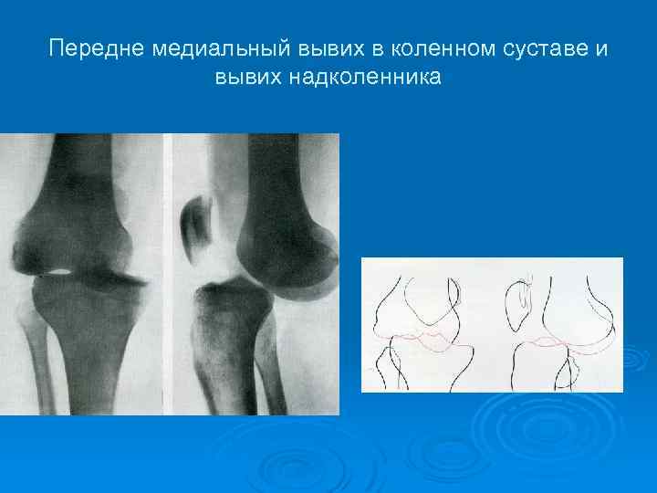 Передне медиальный вывих в коленном суставе и вывих надколенника 