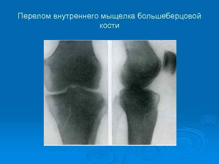 Перелом внутреннего мыщелка большеберцовой