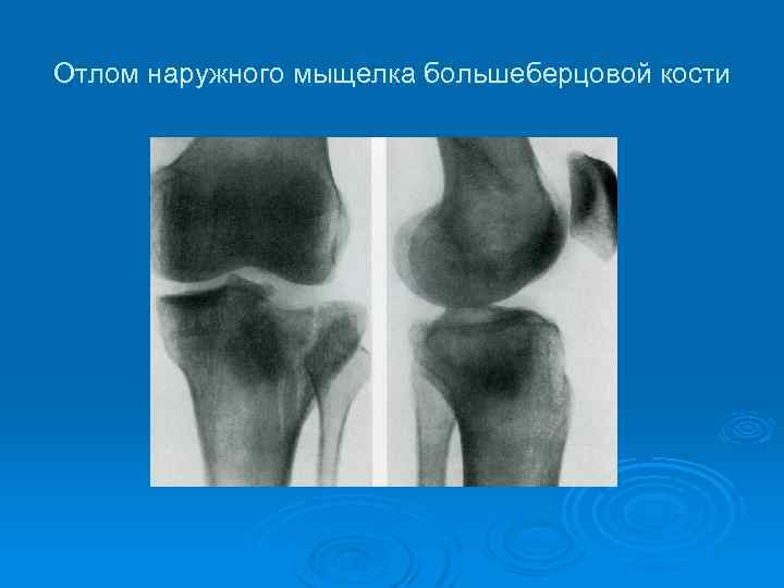 Операция мыщелка большеберцовой кости