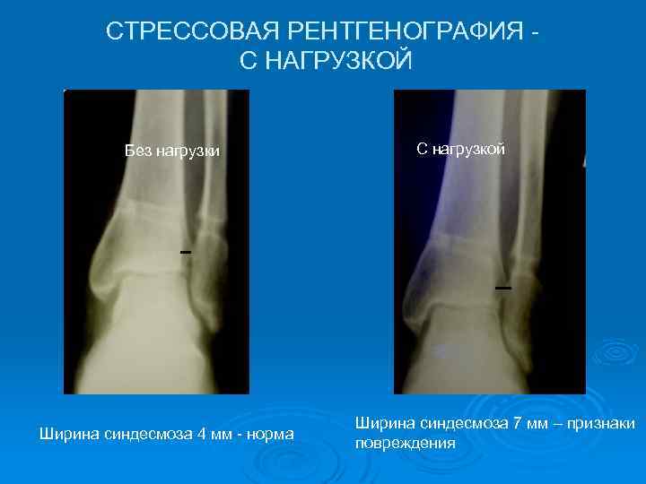 СТРЕССОВАЯ РЕНТГЕНОГРАФИЯ С НАГРУЗКОЙ Без нагрузки Ширина синдесмоза 4 мм - норма С нагрузкой