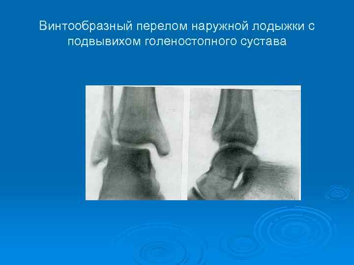 Винтообразный перелом наружной лодыжки с подвывихом голеностопного сустава 