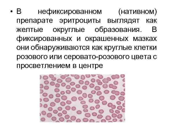  • В нефиксированном (нативном) препарате эритроциты выглядят как желтые округлые образования. В фиксированных