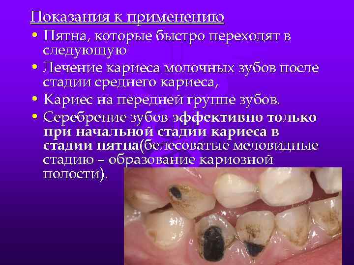 Показания к применению • Пятна, которые быстро переходят в следующую • Лечение кариеса молочных