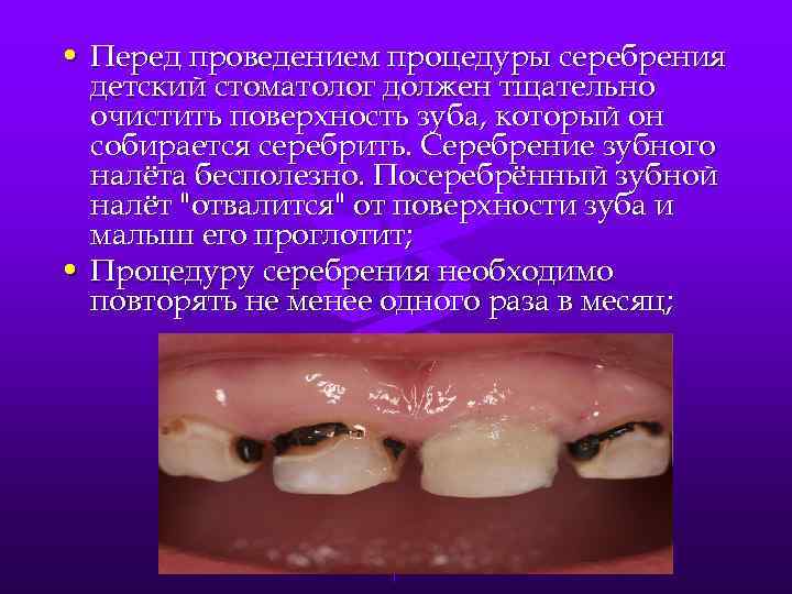  • Перед проведением процедуры серебрения детский стоматолог должен тщательно очистить поверхность зуба, который