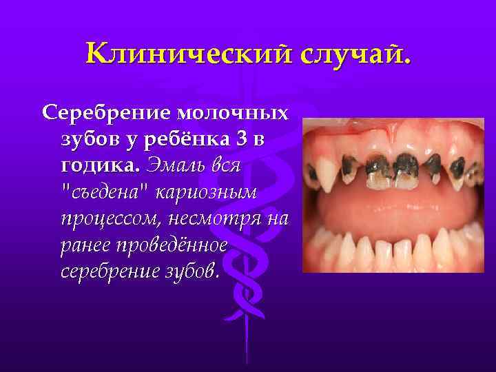 Клинический случай. Серебрение молочных зубов у ребёнка 3 в годика. Эмаль вся 