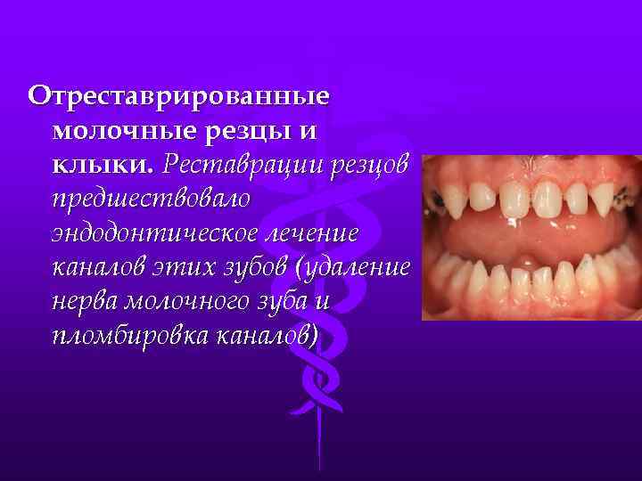 Отреставрированные молочные резцы и клыки. Реставрации резцов предшествовало эндодонтическое лечение каналов этих зубов (удаление