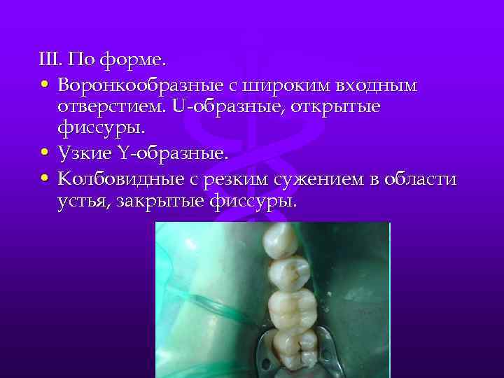 III. По форме. • Воронкообразные с широким входным отверстием. U образные, открытые фиссуры. •