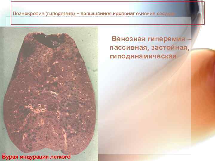 Полнокровие (гиперемия) – повышенное кровенаполнение сосудов Венозная гиперемия – пассивная, застойная, гиподинамическая Острое полнокровие